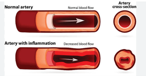Vascular-Inflammation-Blood-Vessels